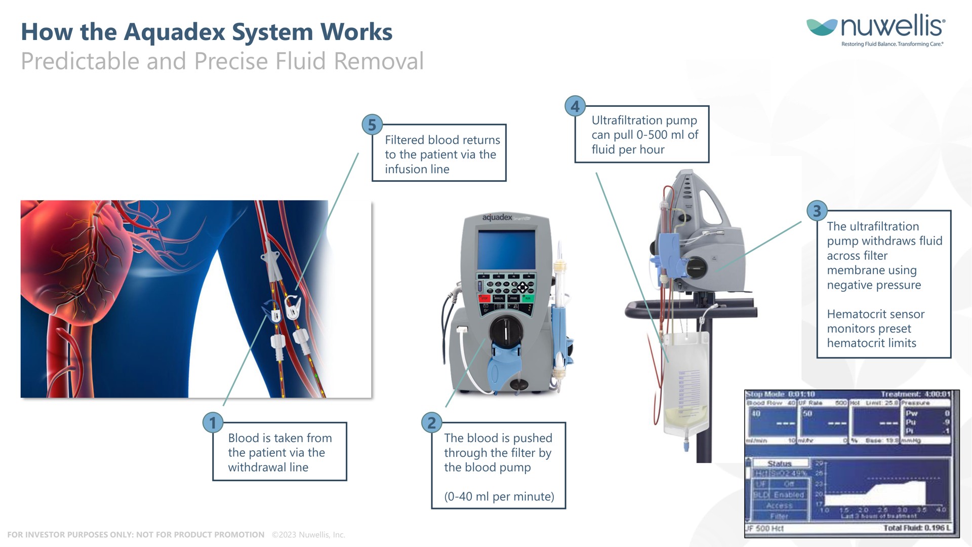 how the system works predictable and precise fluid removal | Nuwellis