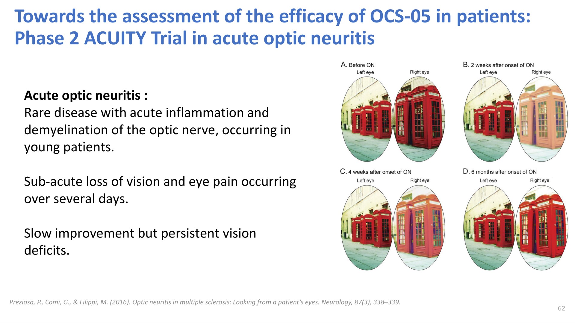 towards the assessment of the efficacy of in patients phase acuity trial in acute optic neuritis | Oculis
