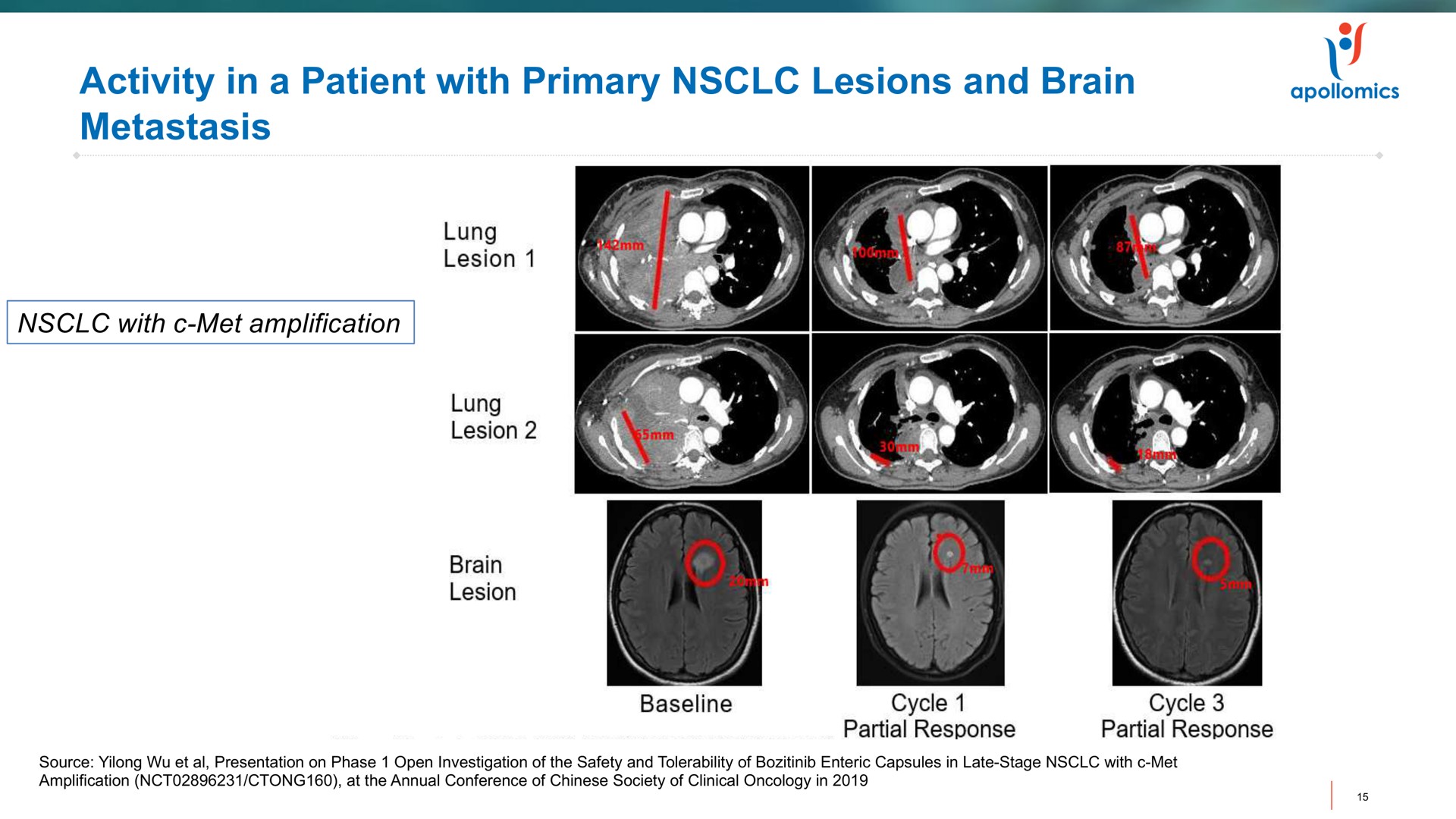 activity in a patient with primary lesions and brain metastasis | Apollomics