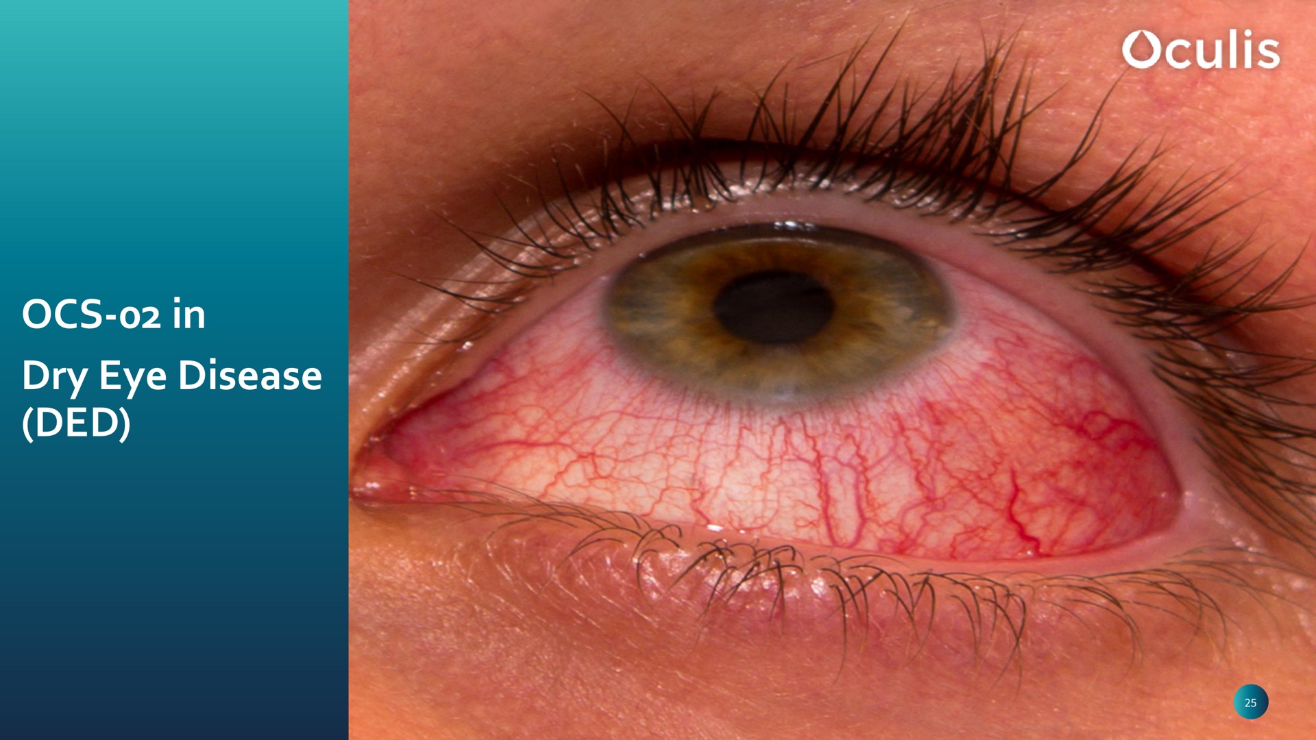 in dry eye disease | Oculis