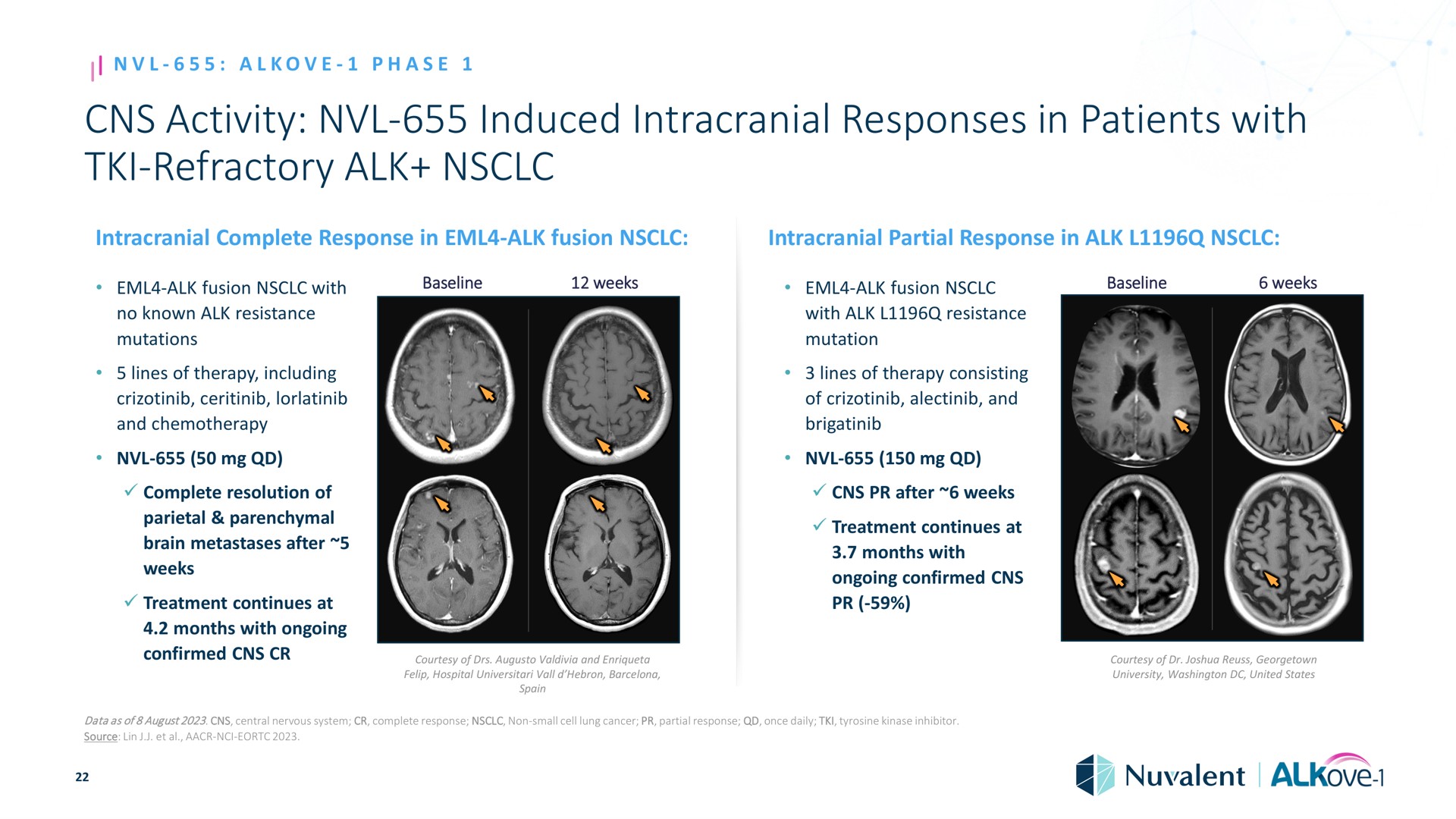 activity induced intracranial responses in patients with refractory alk phase refractory complete response alk fusion alk fusion no known resistance mutations lines of therapy including and chemotherapy complete resolution of parietal parenchymal brain metastases after weeks treatment continues at months ongoing mutation weeks resistance alk fusion partial response ongoing confirmed lines of therapy consisting treatment continues at after weeks of and months weeks confirmed courtesy of and hospital vall barcelona courtesy of university united states data as of august central nervous system complete response non small source lin cell lung cancer partial response once daily tyrosine kinase inhibitor | Nuvalent