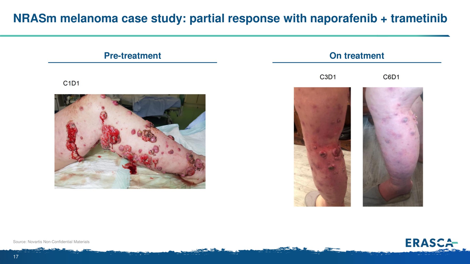 melanoma case study partial response with | Erasca