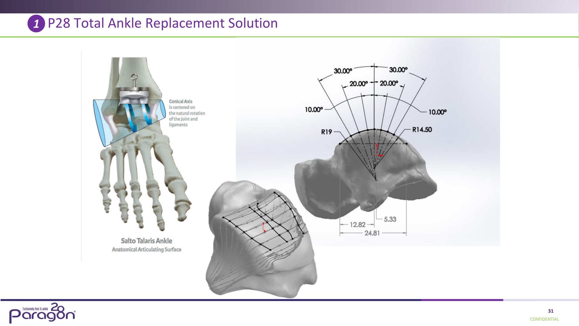 total ankle replacement solution a paragon | Paragon28