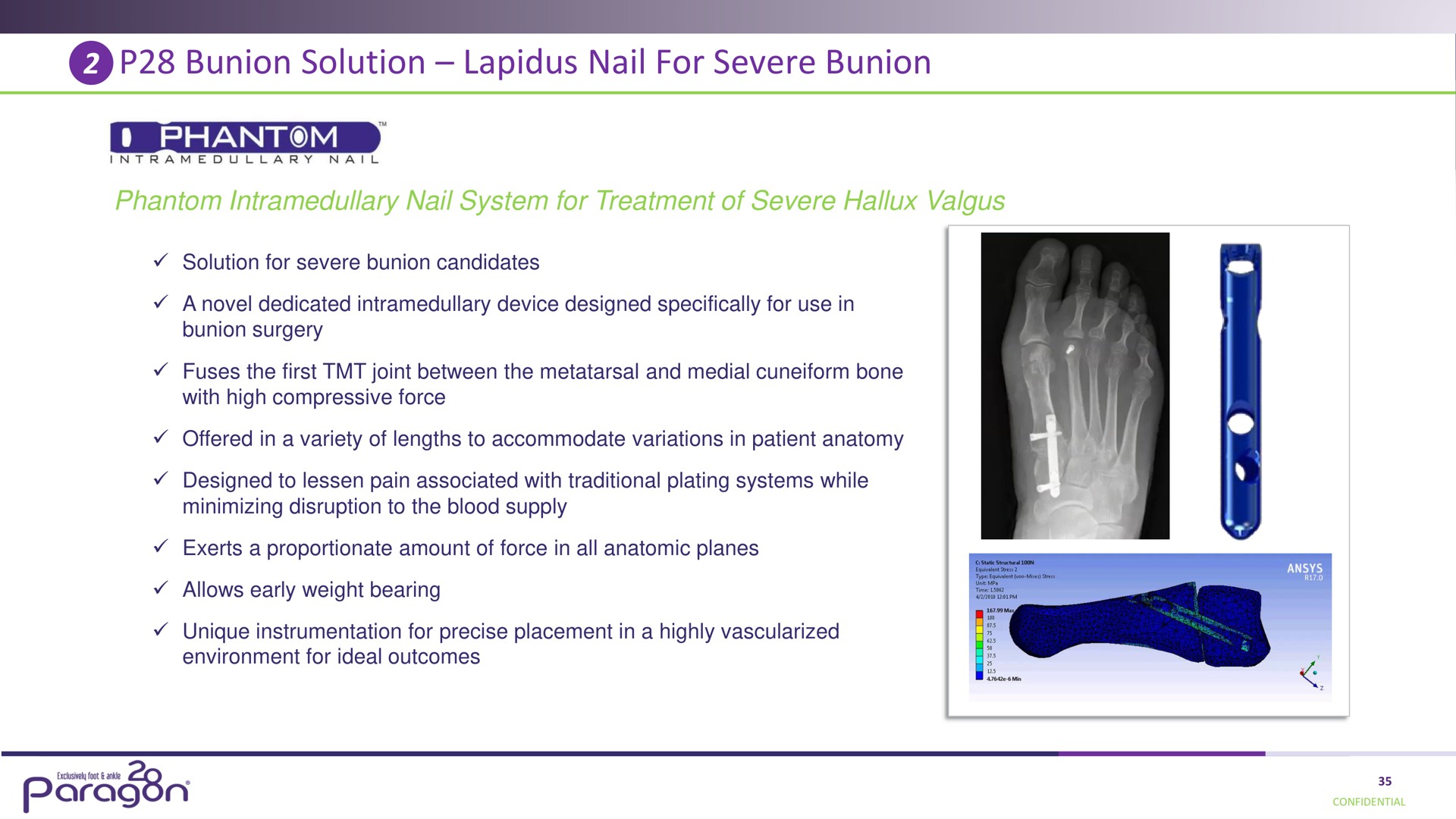 bunion solution nail for severe bunion ose | Paragon28