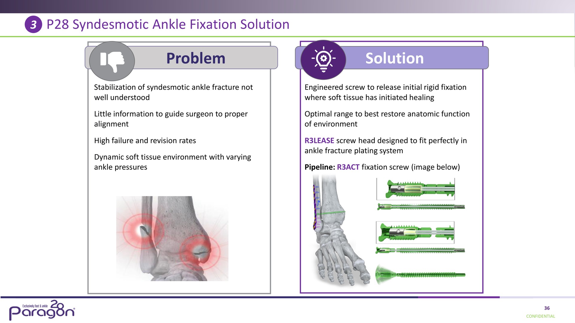 syndesmotic ankle fixation solution problem solution i paragon conn | Paragon28