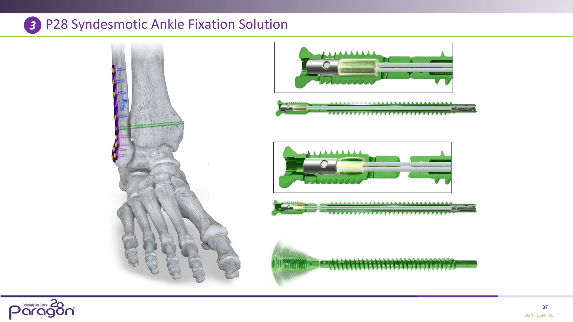syndesmotic ankle fixation solution i paragon | Paragon28