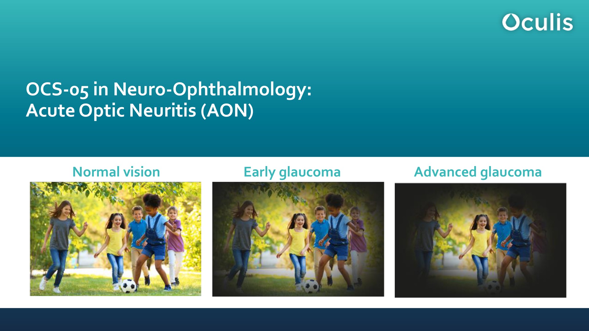 in ophthalmology acute optic neuritis normal vision early glaucoma advanced glaucoma | Oculis