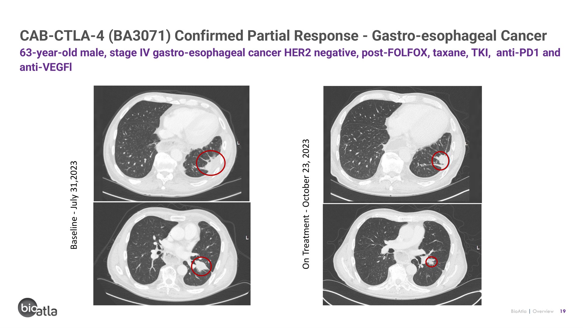 cab confirmed partial response esophageal cancer | BioAtla