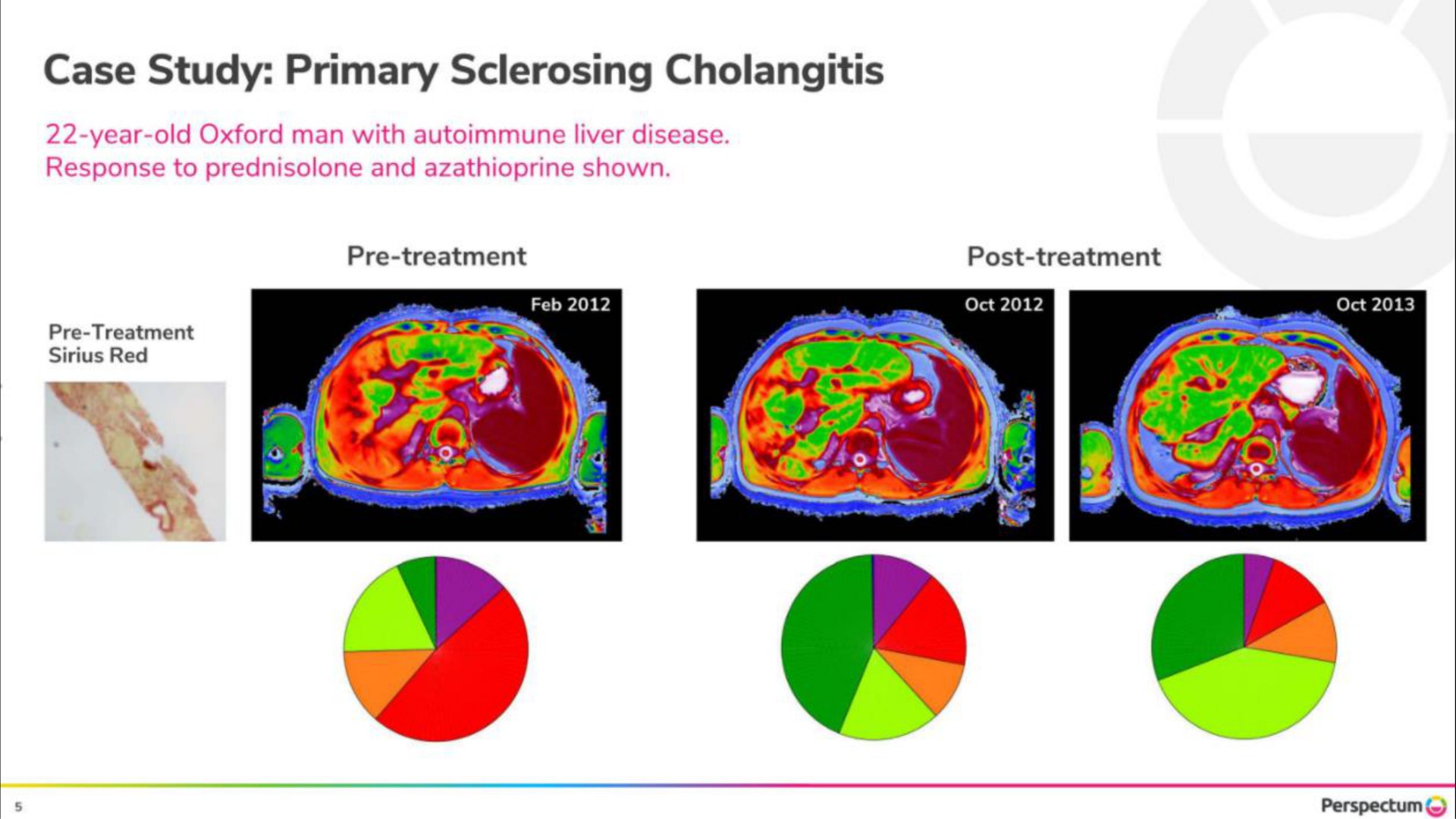 case study primary cholangitis | Perspectum