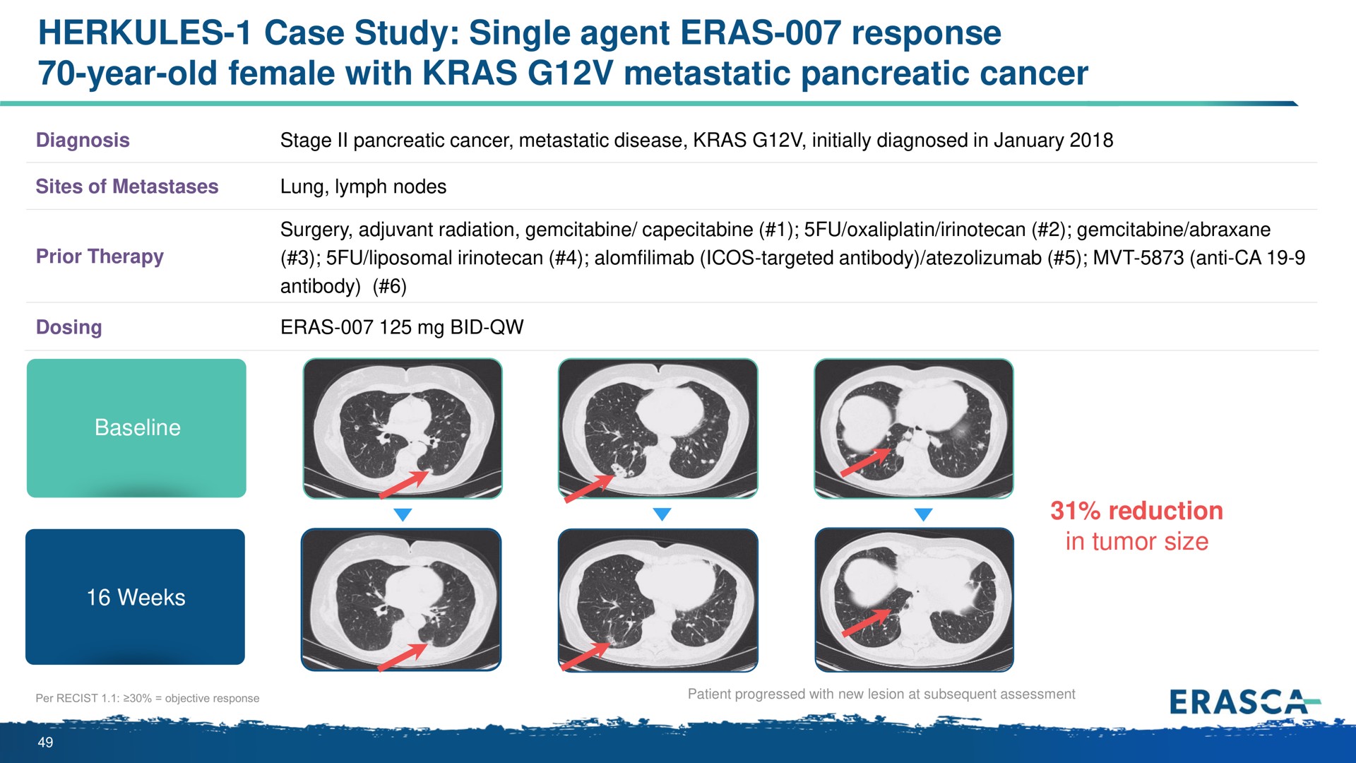 case study single agent eras response year old female with kras metastatic pancreatic cancer | Erasca