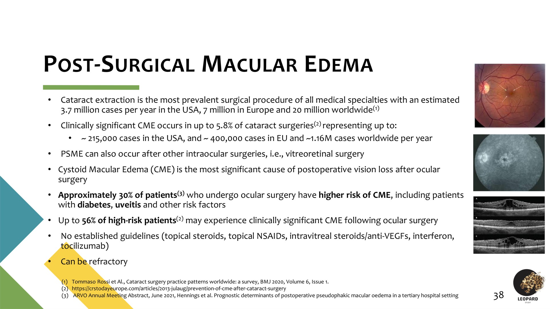 post surgical macular edema | Oculis
