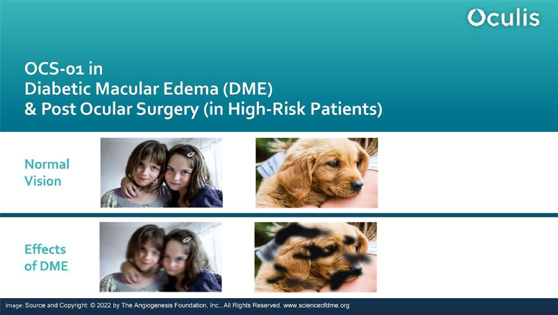 in post ocular surgery in high risk patients | Oculis