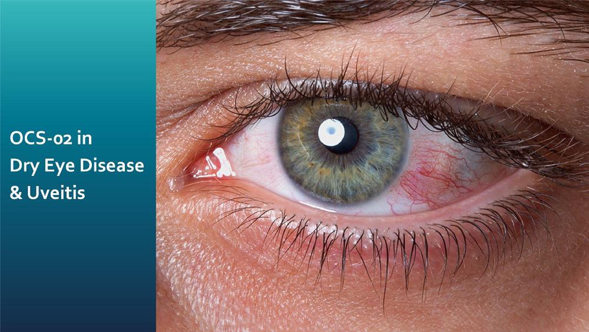 dry eye disease uveitis in | Oculis