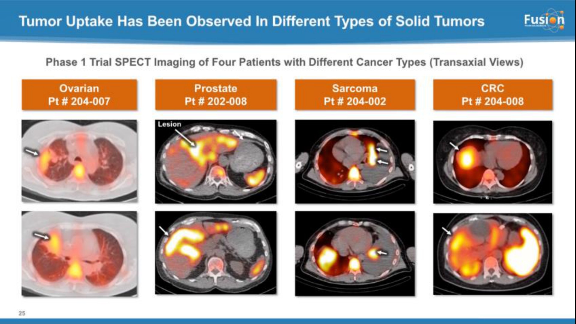 tumor uptake has been observed in different types of solid tumors on | Fusion Pharmaceuticals