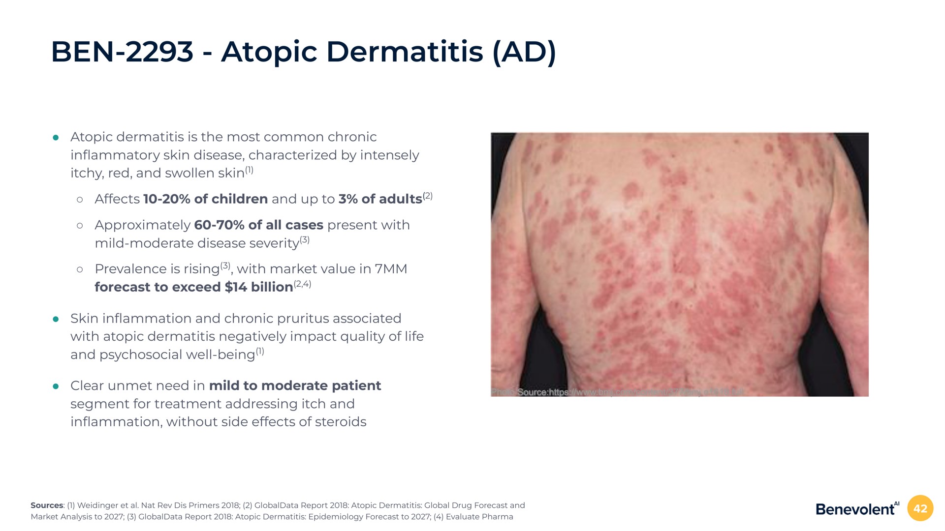 ben atopic dermatitis atopic dermatitis is the most common chronic in skin disease characterized by intensely itchy red and swollen skin affects of children and up to of adults approximately of all cases present with mild moderate disease severity prevalence is rising with market value in forecast to exceed billion skin in and chronic pruritus associated with atopic dermatitis negatively impact quality of life and psychosocial well being clear unmet need in mild to moderate patient segment for treatment addressing itch and in without side effects of steroids | BenevolentAI
