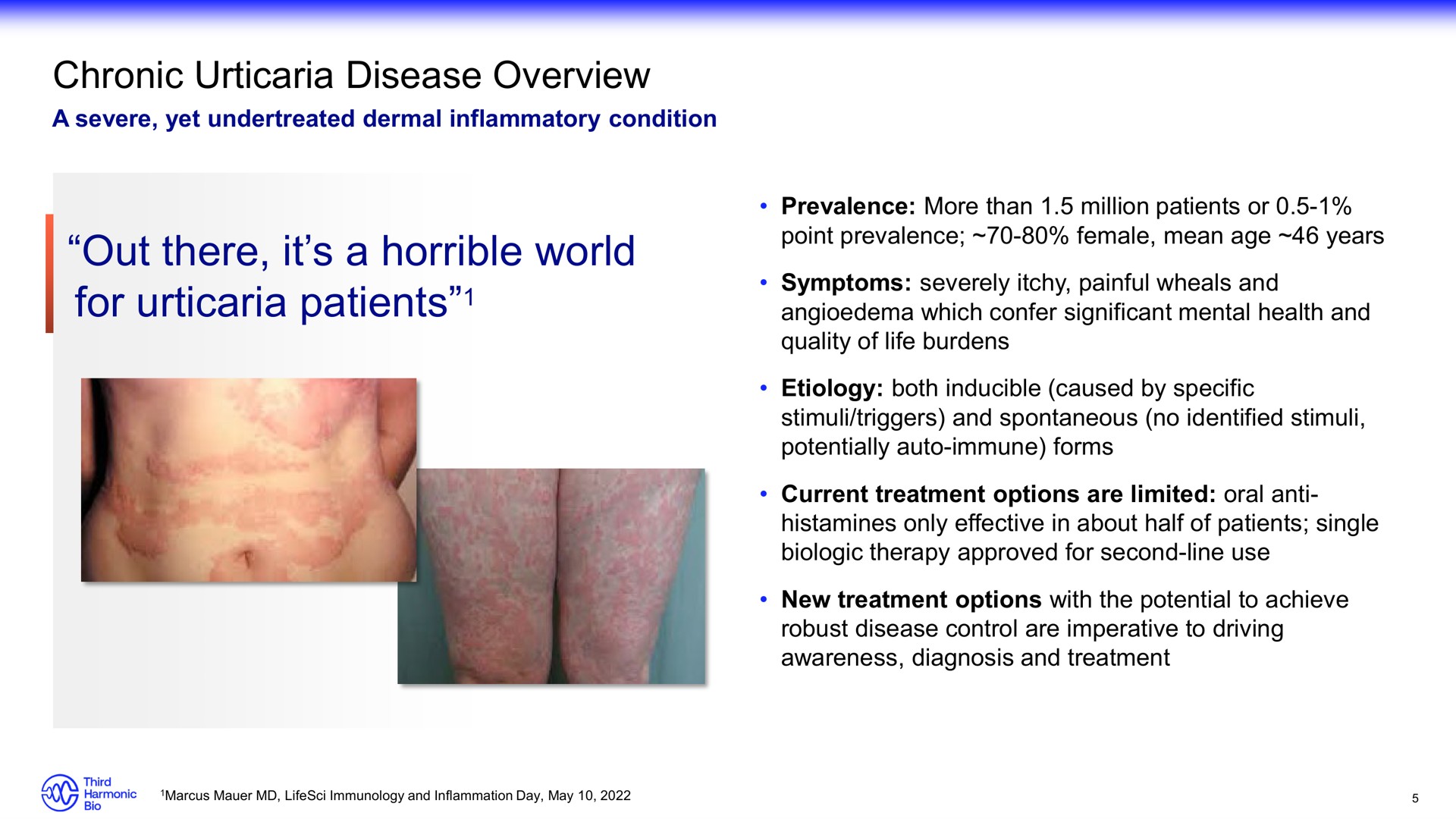 chronic urticaria disease overview out there it a horrible world for urticaria patients | Third Harmonic Bio