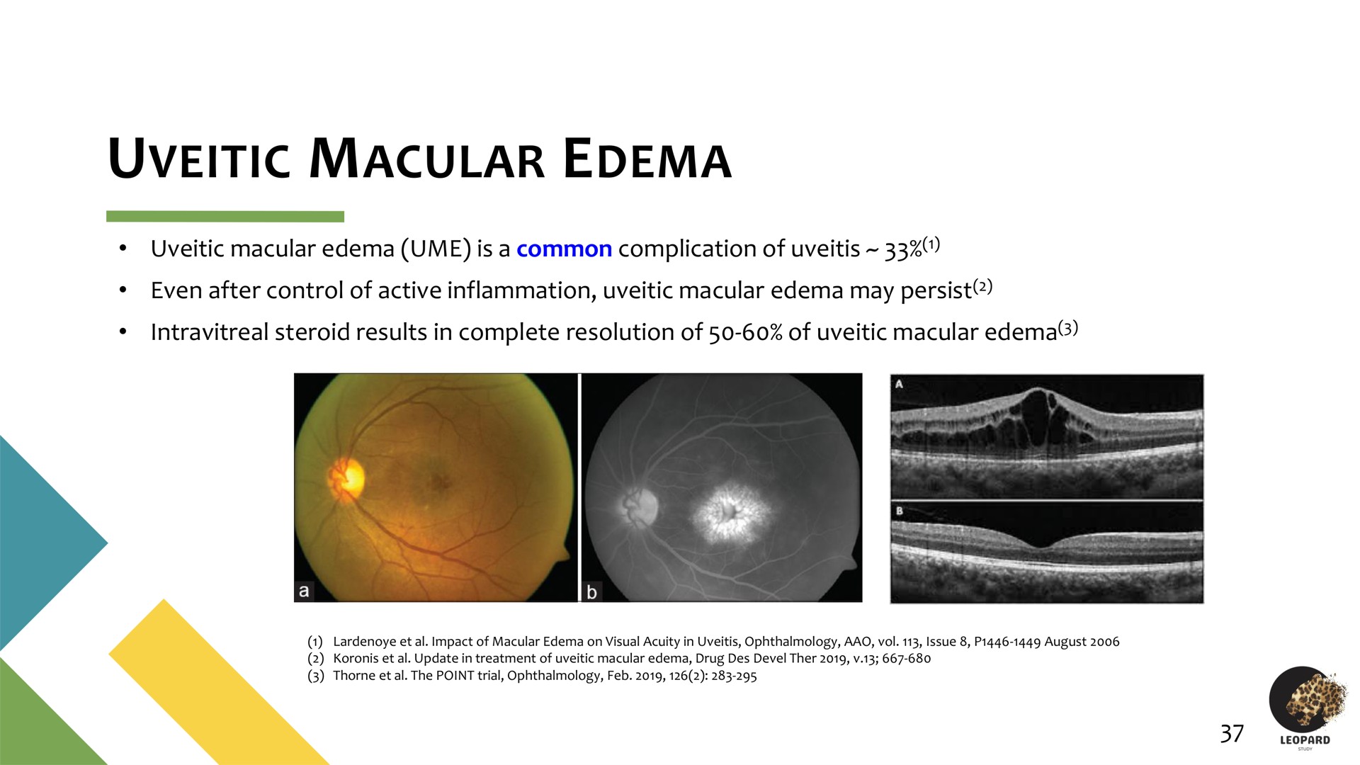 uveitic macular edema | Oculis