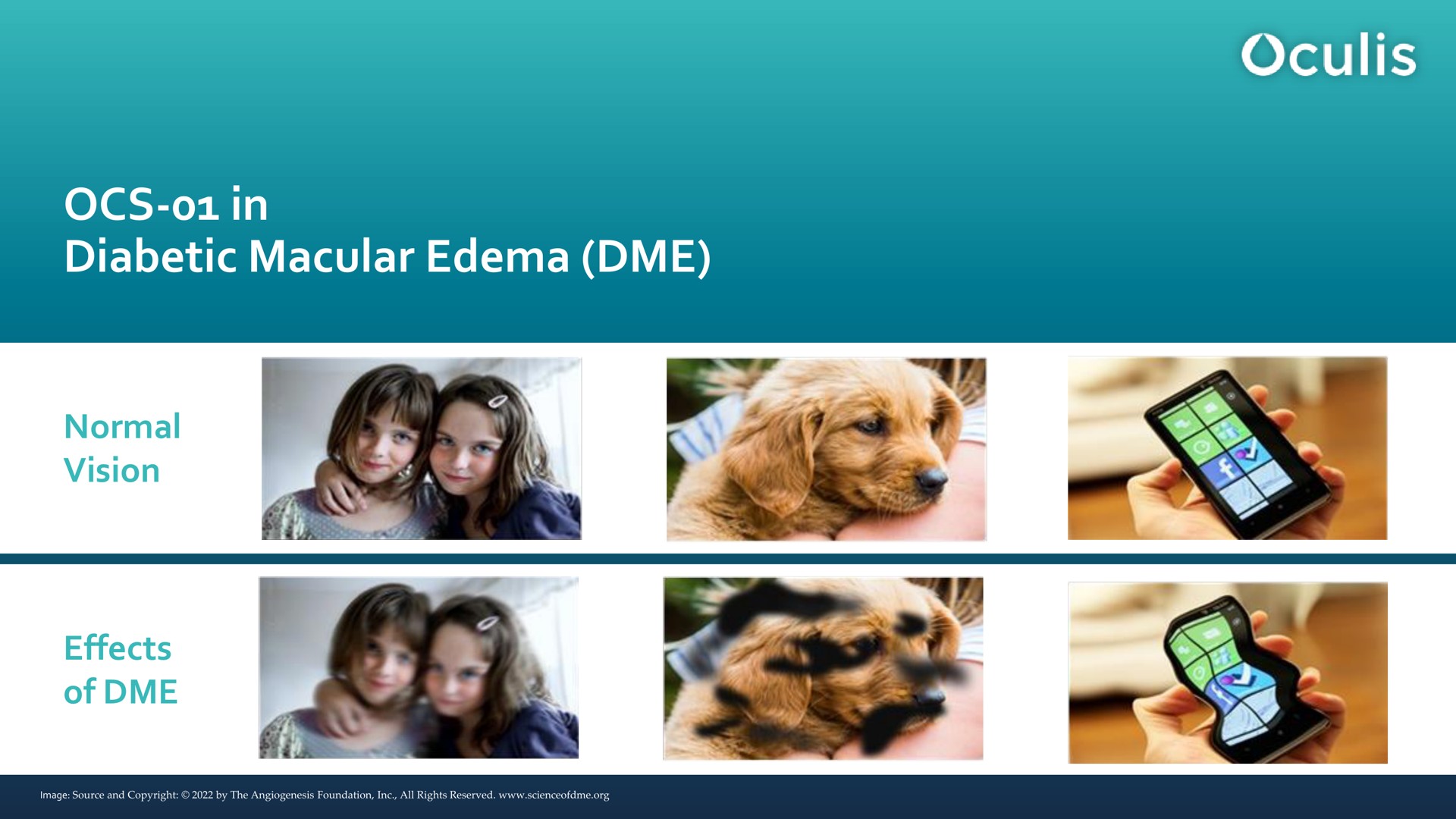 in diabetic macular edema normal vision effects of | Oculis