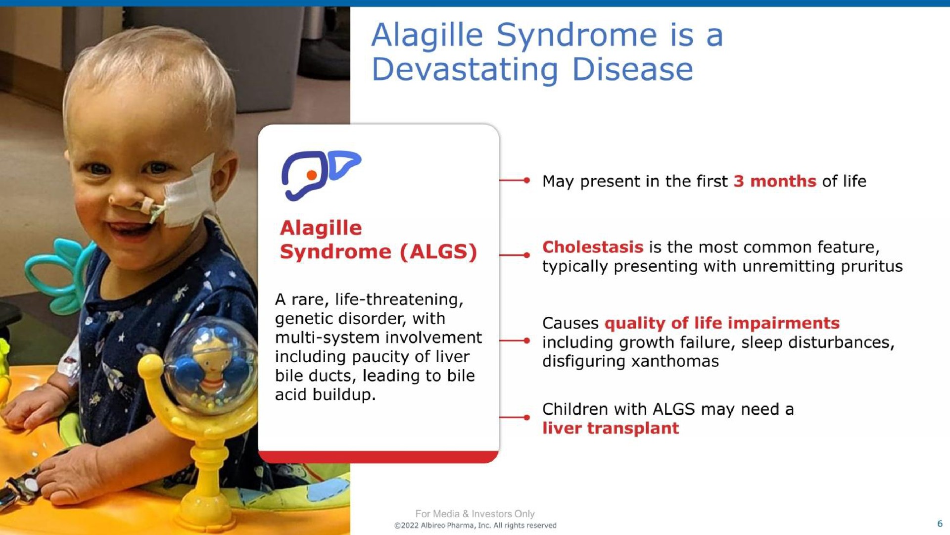syndrome is devastating disease a | Albireo Pharma